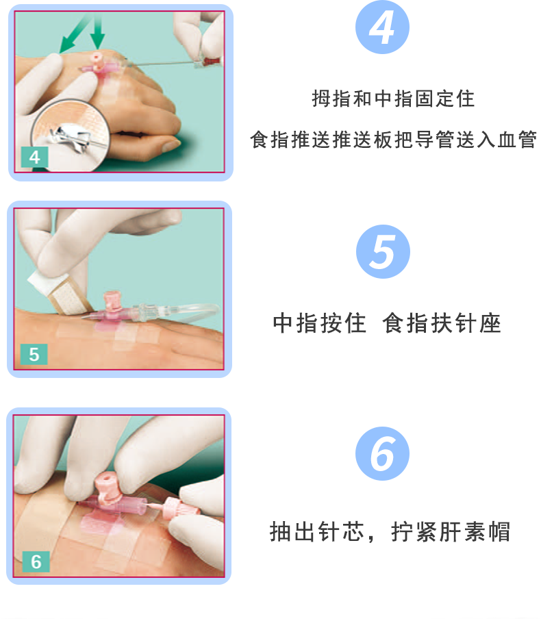 沃素安20G動(dòng)靜脈留置針